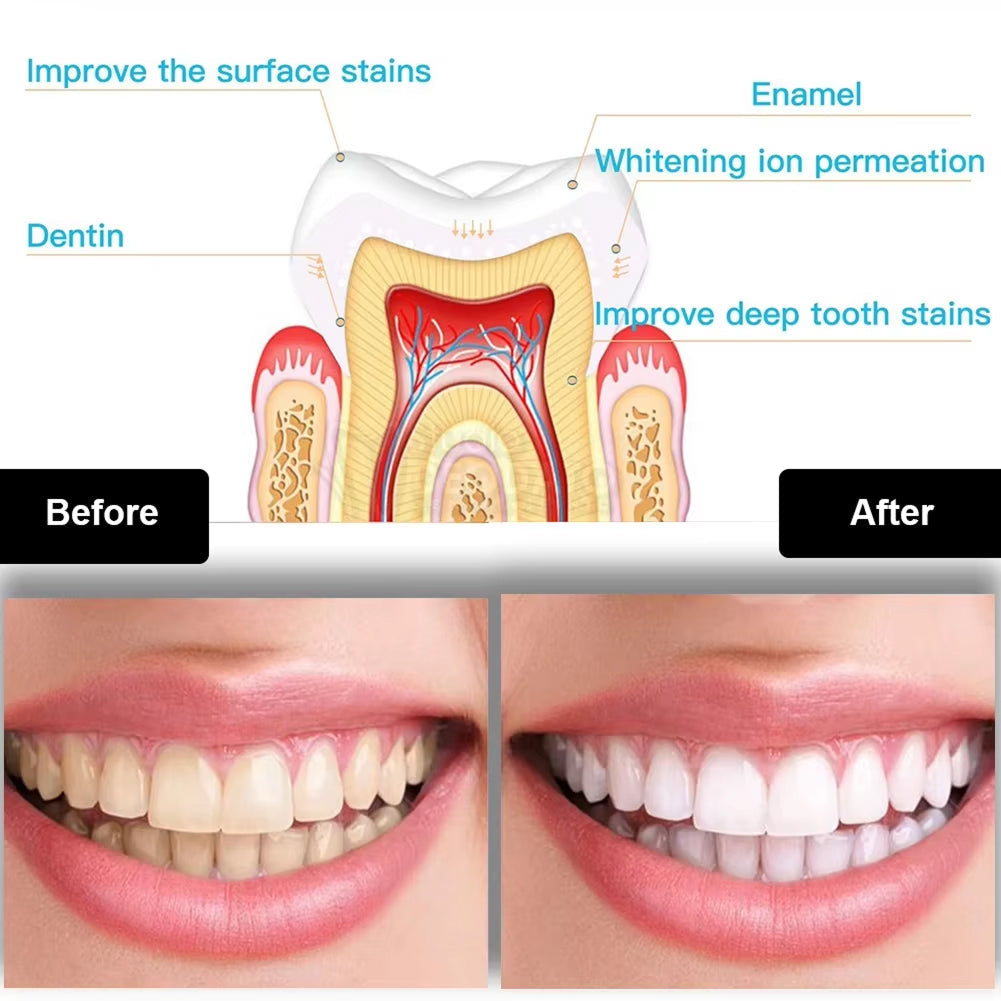 BriteAvi Professional LED Teeth Whitening Kit with 35% Carbamide Peroxide